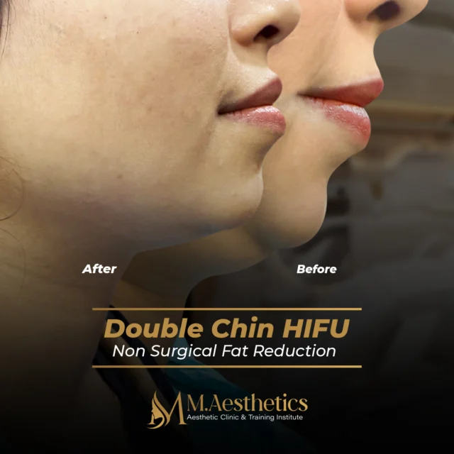 Tired of hiding your double chin?
Our HIFU Double Chin Treatment melts fat and tightens skin – no cuts, no downtime! 💆‍♀️✨
✅ Non-Surgical
✅ Quick & Painless
✅ Visible Results After One Session

#HIFU #DoubleChinRemoval #NonSurgical #MAesthetics #ChinLifting #FatReduction #SkinTightening